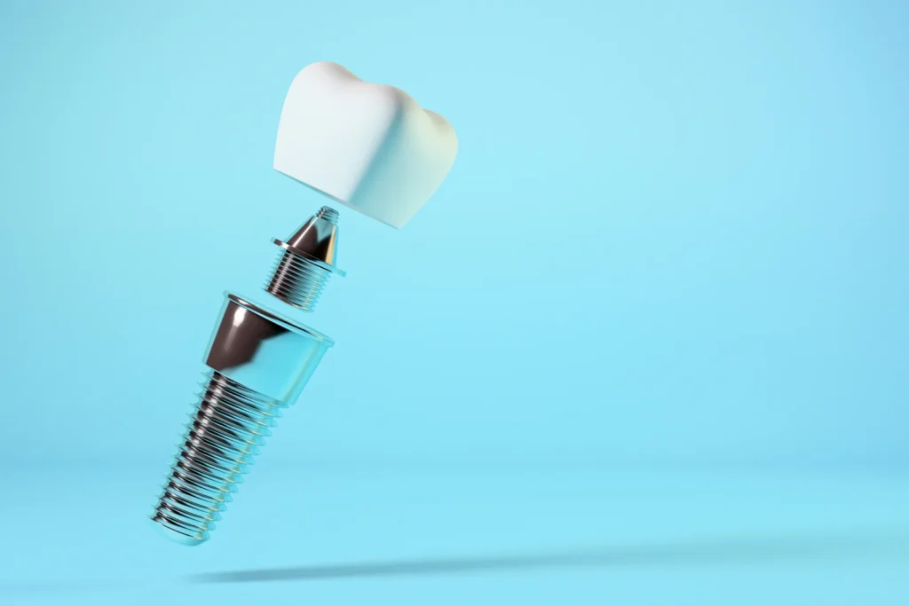 Dental implants 2 jpeg