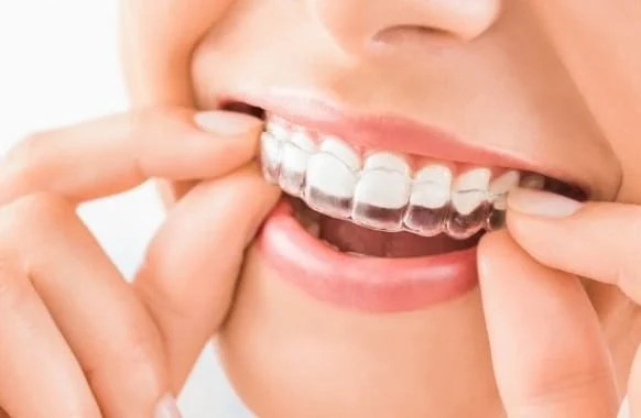 Invisalign box img